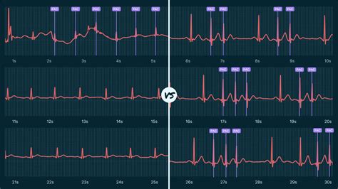 Ectopic Atrial Rhythm Vs. Supraventricular Tachycardia (Non-Sustained) on Your Watch ECG | Qaly