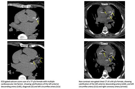 Artificial Intelligence in Coronary Artery Calcium Scoring Detection ...