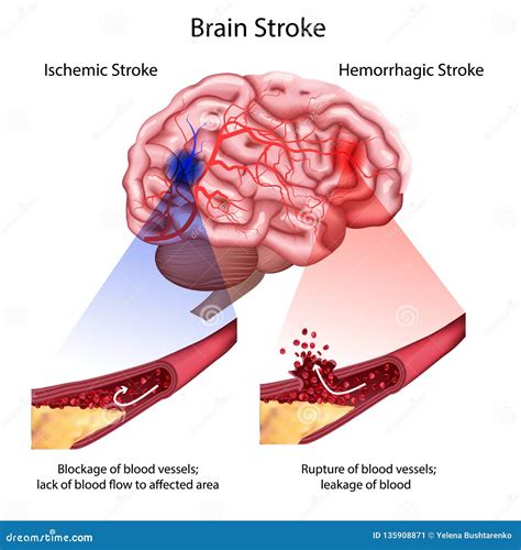 Brain Blood Clot Royalty-Free Illustration | CartoonDealer.com #69847503