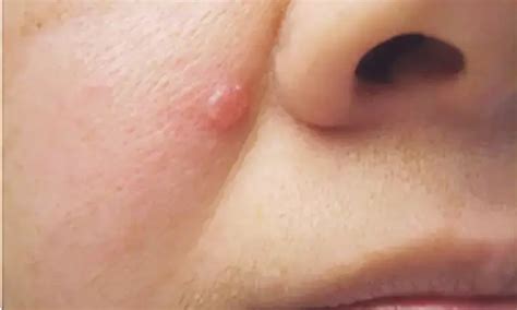 History of rosacea protective factor against facial BCC development