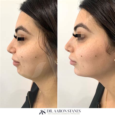 Chin Augmentation | Chin augmentation, Dermal fillers, Beauty