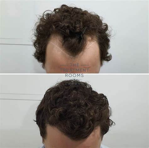 What Is A Widow's Peak? | The Treatment Rooms London