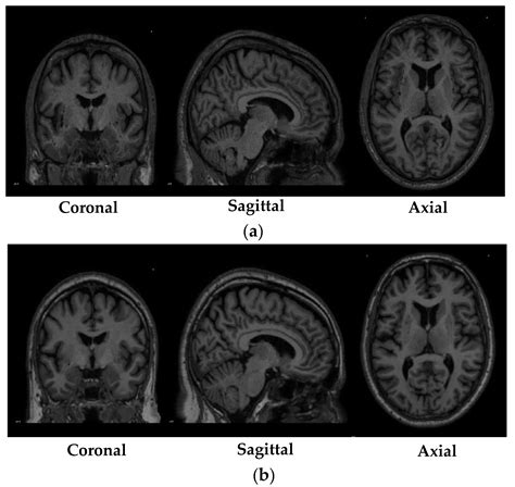 Detection of Parkinson’s Disease from 3T T1 Weighted MRI Scans Using 3D ...