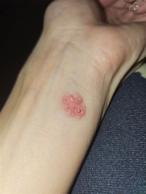 Cluster of itchy fluid filled bumps on wrist : r/DermatologyQuestions