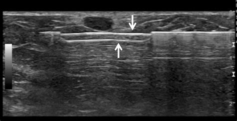 Ultrasound‐Guided Breast Biopsies - Bhatt - 2021 - Journal of Ultrasound in Medicine - Wiley ...