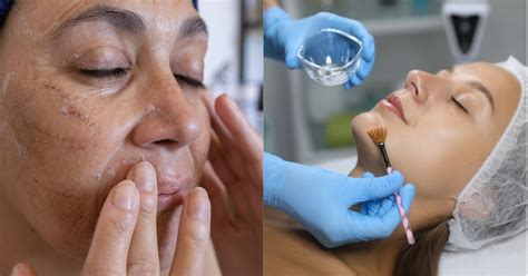 Chemical Peel at Home vs. In-Clinic: Which Is Better?