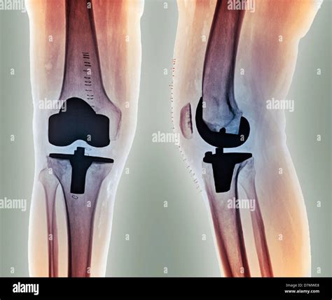 Total knee replacement hi-res stock photography and images - Alamy
