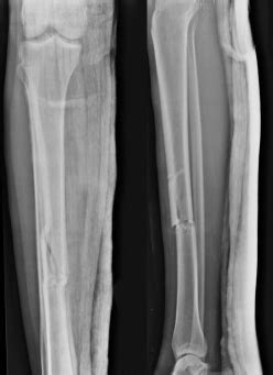 Understanding Tibia Fracture Healing Time in Adults: Guide