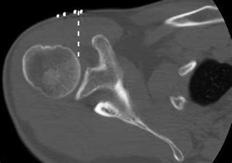 CT-Guided Shoulder Arthrography at the Rotator Cuff Interval | AJR