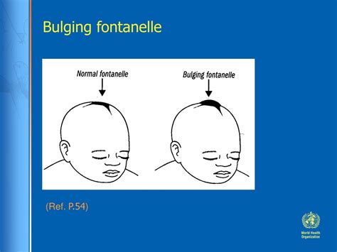 Normal Vs Bulging Fontanelle
