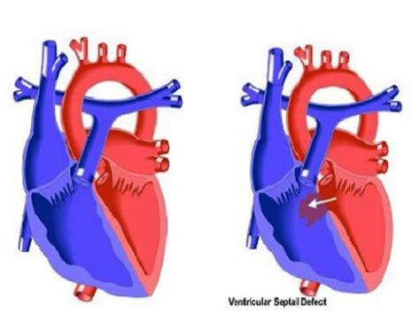 VSD - Ventriküler septal defekt