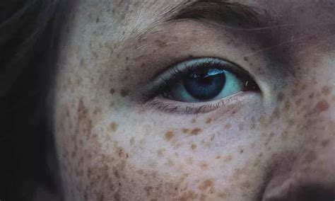 577-nm yellow laser effective, safe, and well-tolerated device in ...