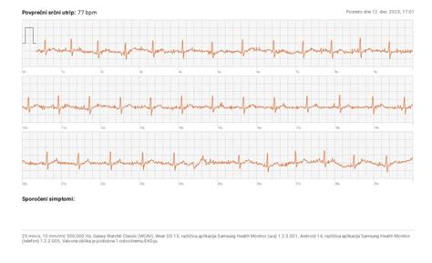 Image result for PVC ECG Reading