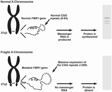 Fragile X syndrome causes, inheritance, symptoms, diagnosis & treatment