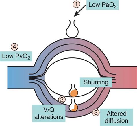 Image result for Hypoxemia Algorithm