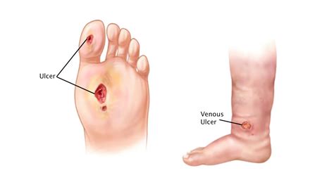 Necrotic Pressure Ulcer Non Healing Wounds Or Ulcers Symptoms,