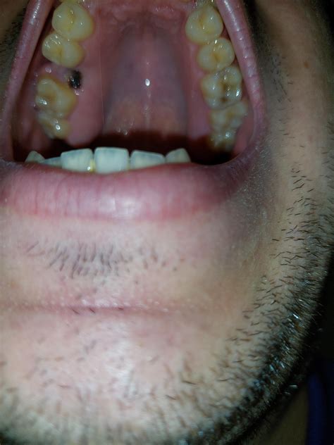 What is that black hole? : r/askdentists