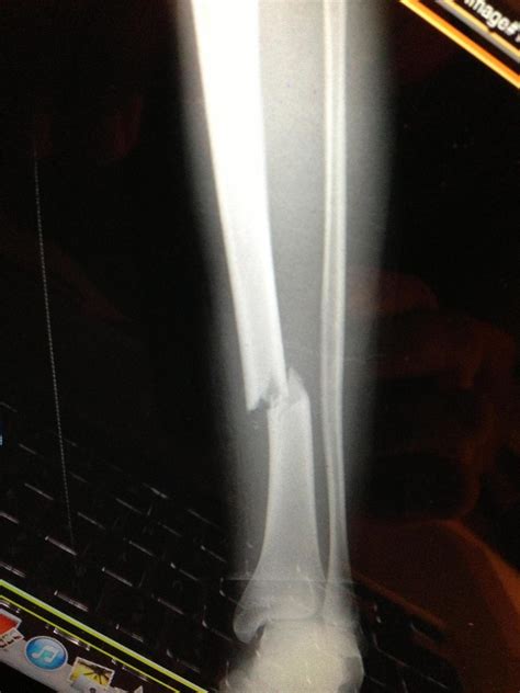 Tibia Shaft Fractures - Trauma - Orthobullets.com