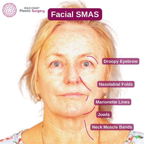 Facelift Scars: Post-Surgery Expectations and Tips