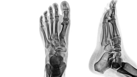 Traumatic Arthropathy Foot And Ankle