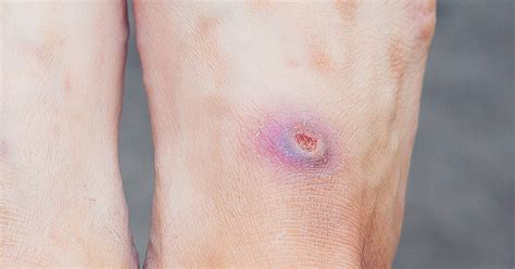 Pressure Sores On Feet