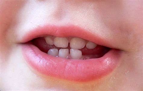 Why Do Babies Grind Their Teeth? - Mum Stuff