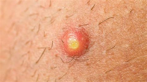 Image result for Exploding Pimple On Bottom