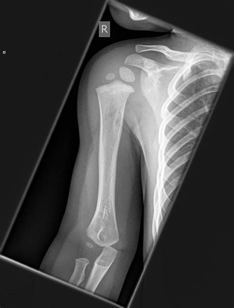 Normal X Ray Shoulder Child at Terry Haskell blog