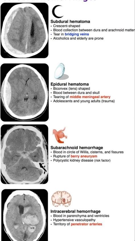 Subdural vs epidural hematoma neurology nursing and medical notes – Artofit