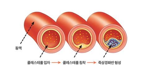 고지혈증 증상 9가지