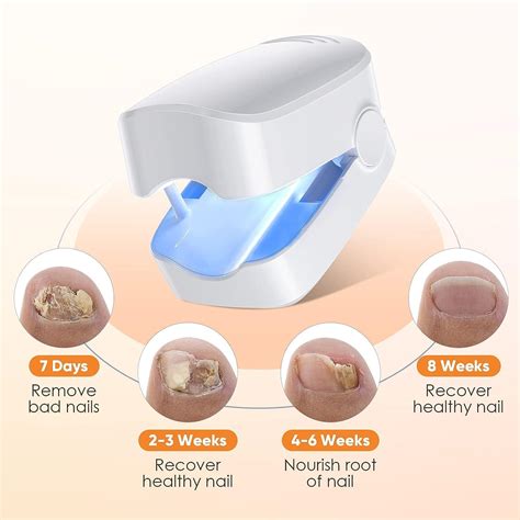 Nail Fungus Laser Treatment Device for Fingernails and Toenails - Home Use Treatment Kit with ...