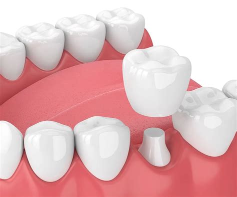 Expert Dental Crown Solutions In Preet Vihar, East Delhi
