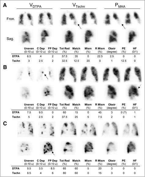 Ventilation–Perfusion SPECT with 99mTc-DTPA Versus Technegas: A Head-to ...
