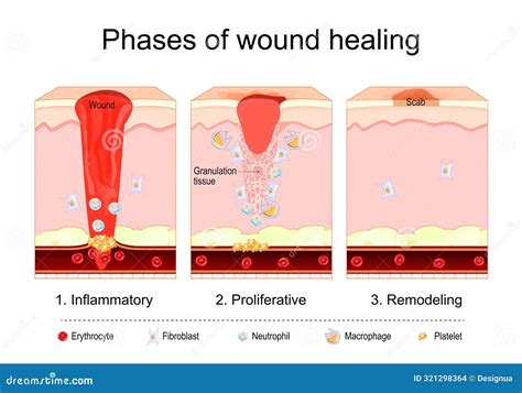 Wound Healing Process. Tissue Repair Stock Vector - Illustration of skin, vein: 321298364