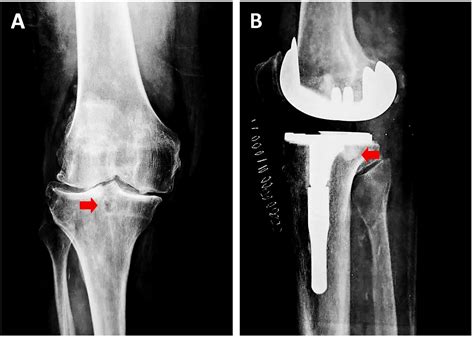 Subchondral Sclerosis