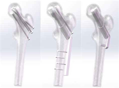 Image result for Lrather Fixation