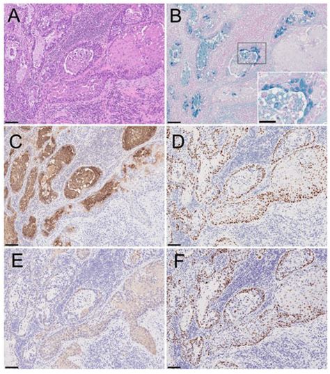 Adenosquamous Carcinoma with the Acantholytic Feature in the Oral ...
