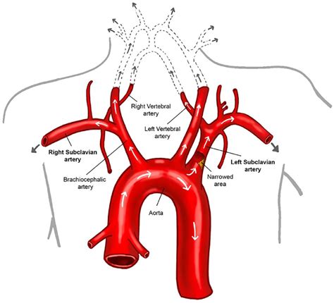 Subclavian Artery Branches Anatomy Arterial Supply To The Upper Limb