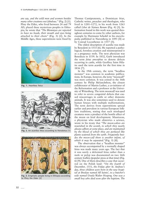 SOLUTION: Twin reversed arterial perfusion syndrome in historical ...