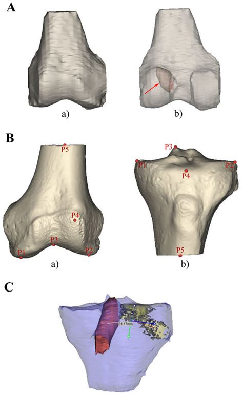 The Influence of Bone Bruises on Bone Tunnel Enlargement Regarding ACL ...