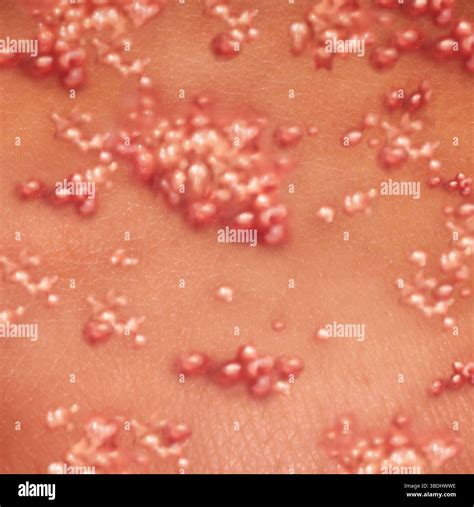 Herpes zoster hi-res stock photography and images - Alamy