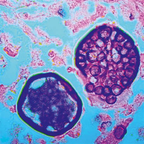 Seltene pulmonale Mykosen: Reisemitbringsel oder doch schon heimisch ...