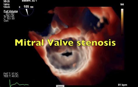 Mitral Valve Stenosis: 3D TrueVue - Echovision