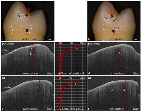 Dental Applications of Optical Coherence Tomography (OCT) in Cariology
