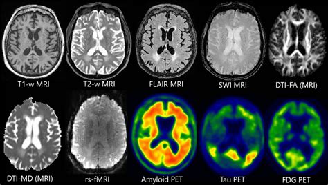 Uses of Human MR and PET Imaging in Research of Neurodegenerative Brain Diseases - Neurotherapeutics
