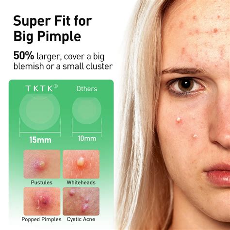 Huge Zit On Forehead