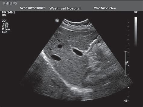 Caudate Lobe Of Liver Ultrasound