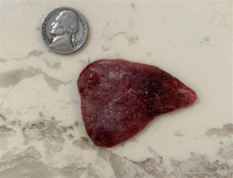 Bumpy Blood Clot Menstrual Causes And Symptoms Of Large Period Blood