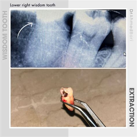 Wisdom Tooth Cyst Removal 的图像结果