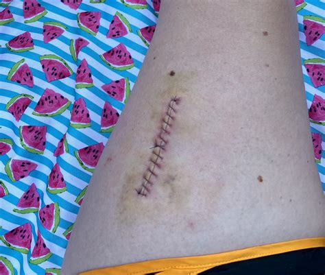 One week post Wide Local Excision for stage 1 melanoma and I got the ...